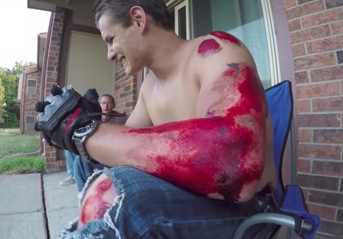 Doku Kaybı - Koruma - düşmüş erkek kol yaraları